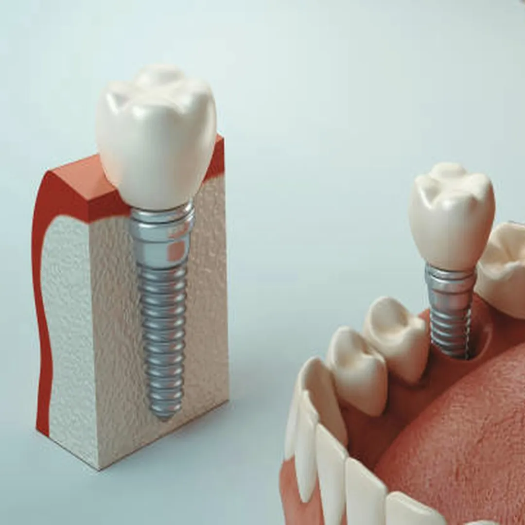 Modelo de un implante dental con su corona.
